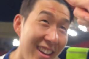奖杯印记?孙兴慜额头挂彩：我捧杯时有人推我，蹭到了